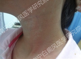 南宁西京白癜风医院