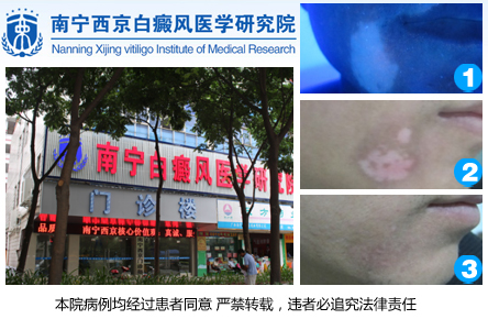 南宁市白癜风医院
