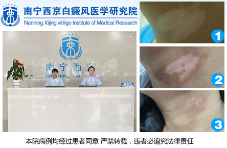 南宁市治疗白癜风的医院