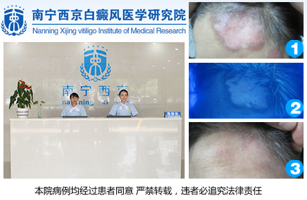 南宁治疗白癜风.jpg
