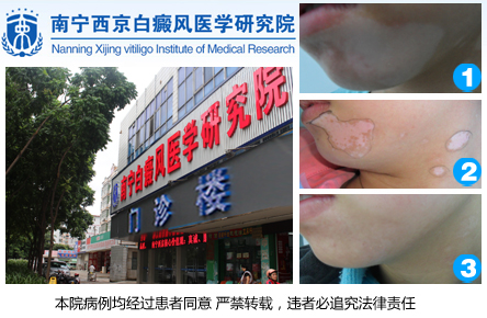 南宁白癜风治疗.jpg