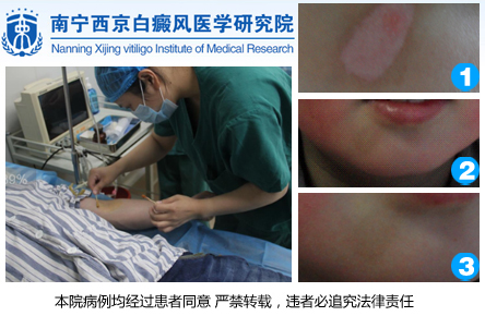 南宁白癜风.jpg