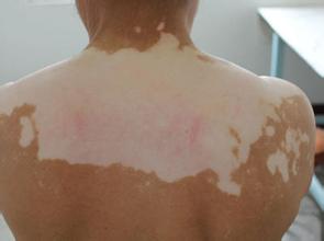 诊断白癜风的方法