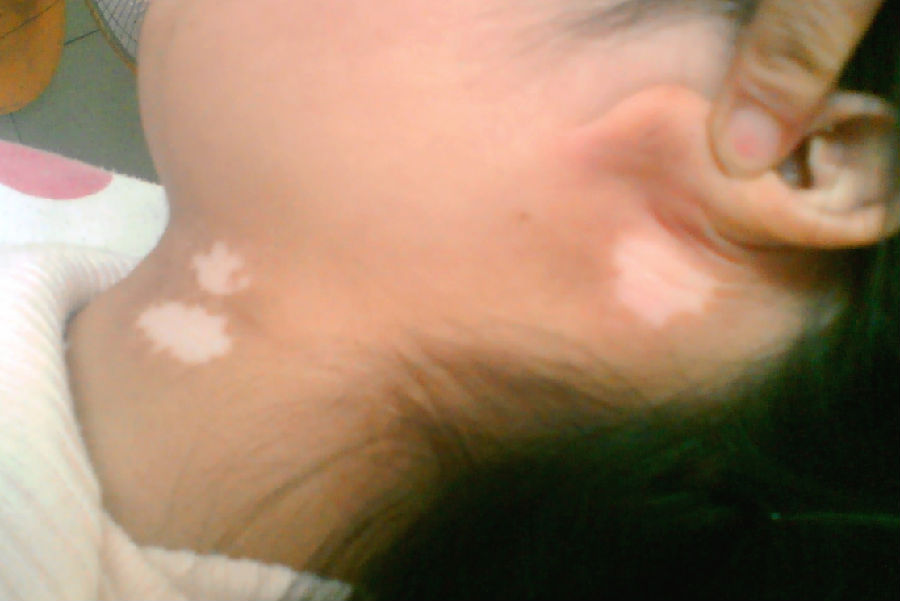 白癜风对孩子的危害