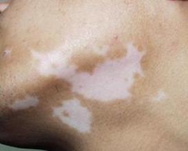 白癜风的危害主要表现