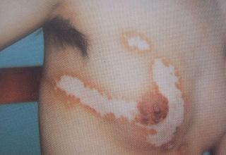 白癜风的治疗原则有哪些?