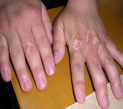 白癜风的治疗误区