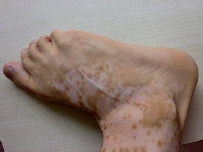 患上白癜风的症状有哪些