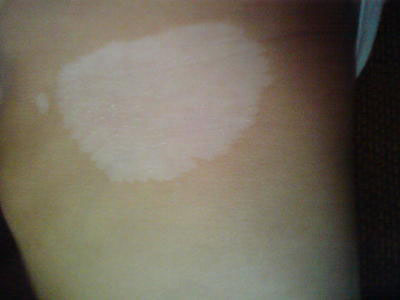 白癜风有什么症状呢