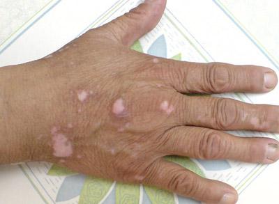 患上白癜风有哪些调节方法