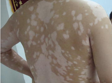 白癜风的诊断依据是哪些?