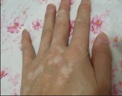 专家介绍白癜风预防有哪些方法