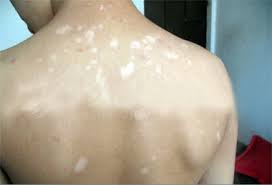 有效预防白癜风的方法有哪些