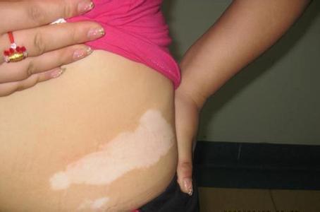 产妇白癜风应该如何护理呢?