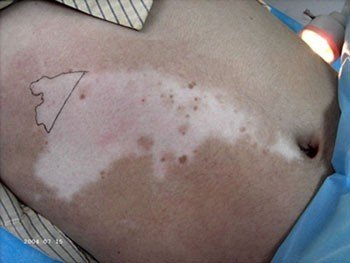 孕妇白癜风注意事项有哪些