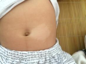 减肥也要注意患上白癜风