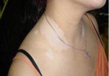 白癜风是不是遗传病