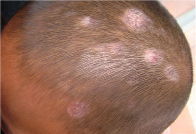 头部白癜风要注意哪些生活细节