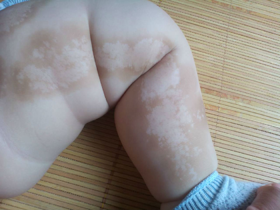 儿童白癜风的症状有哪些