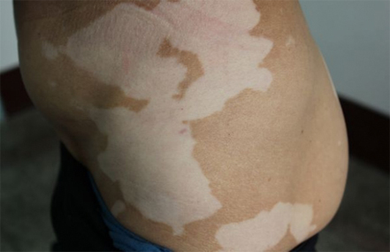 白癜风的症状表现