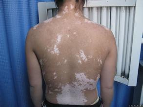 治疗白癜风要注意哪些