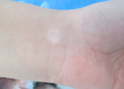 白癜风会给患者带来哪些危害