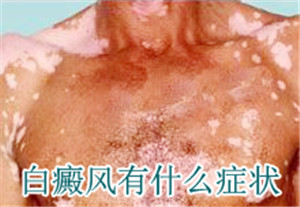 患了白癜风会出现什么症状
