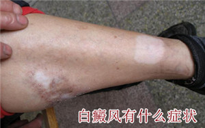 白癜风早期症状表现在哪些方面