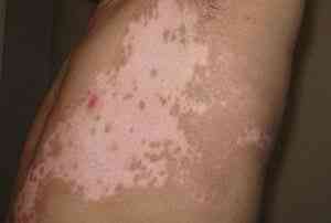 白癜风症状都是哪些