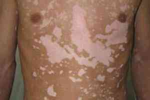 白癜风的日常护理有哪些有效的措施