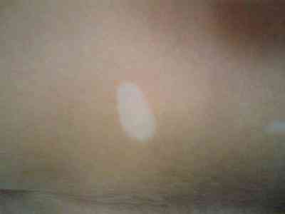 白癜风患者在日常生活中应该注意哪些