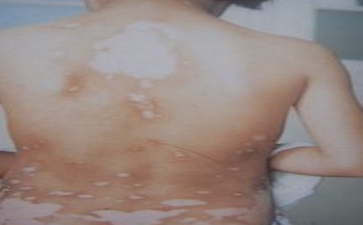 节段型白癜风的症状有哪些