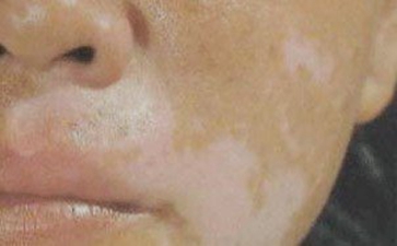 散发型白癜风该怎么治疗