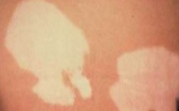 白癜风患者如何治疗养生