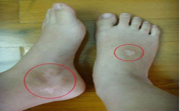 白癜风如何治愈偏方有哪些