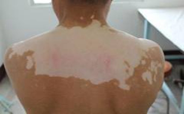 白癜风的预防注意事项是什么