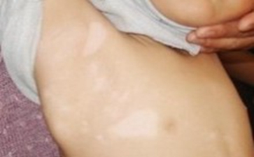 白癜风患者如何进行心理治疗