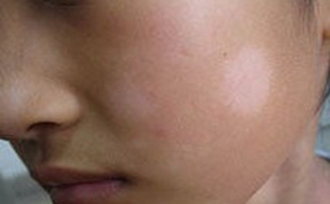 面部白癜风的治疗方法有哪些