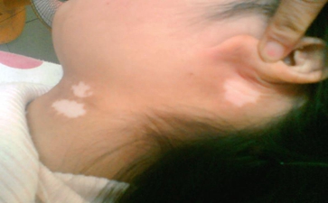 ÖÎÁƾ±²¿°×ñ°·çÐèҪעÒâʲô