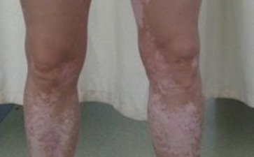 Ë«ÍȰ×ñ°·çµÄÖÎÁÆÄÄÖÖÓÐЧ