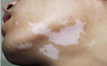 青少年白癜风疾病该如何治疗