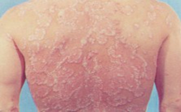 女性白癜风的预防有哪些方法