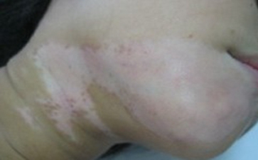 局限性白癜风是什么呢