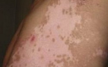 什么偏方治白癜风效果好呢