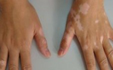 预防白癜风的方法有哪些