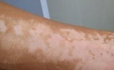 白癜风常见的预防办法有哪些