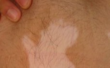 白癜风患者的心理有哪些方法