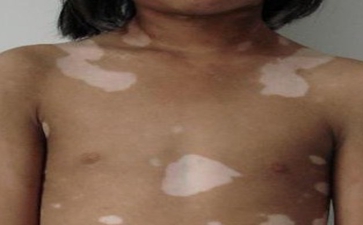 胸部白癜风会出现哪些症状