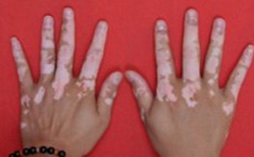 手上为什么会发病白癜风