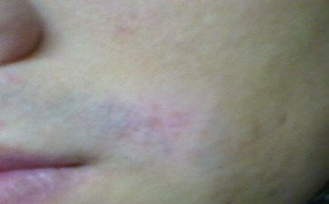 男性白癜风容易诊断吗